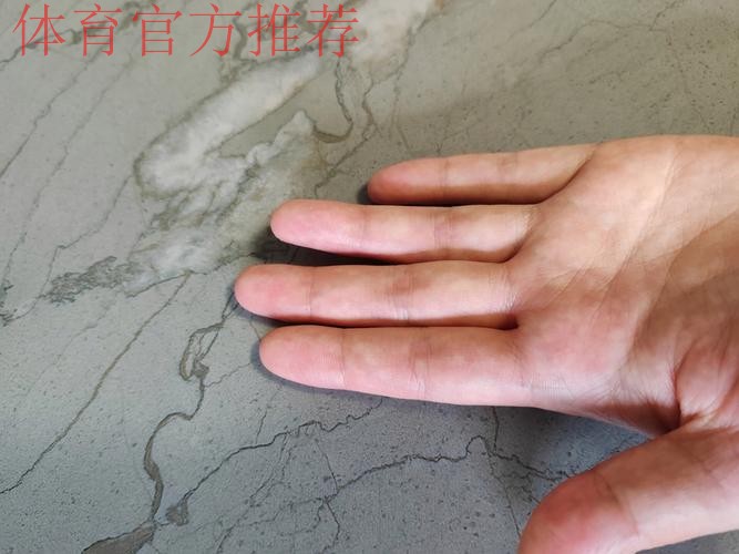 Siegel:康查尔左手拇指尺侧副韧带撕裂,三周后复查 Siegel:康查尔左手拇指尺侧副韧带撕裂,三周后复查